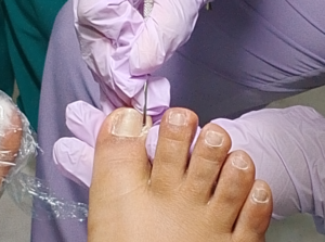 matricectomia