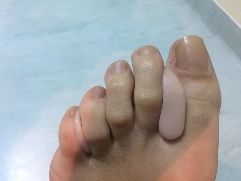 ortoplastia