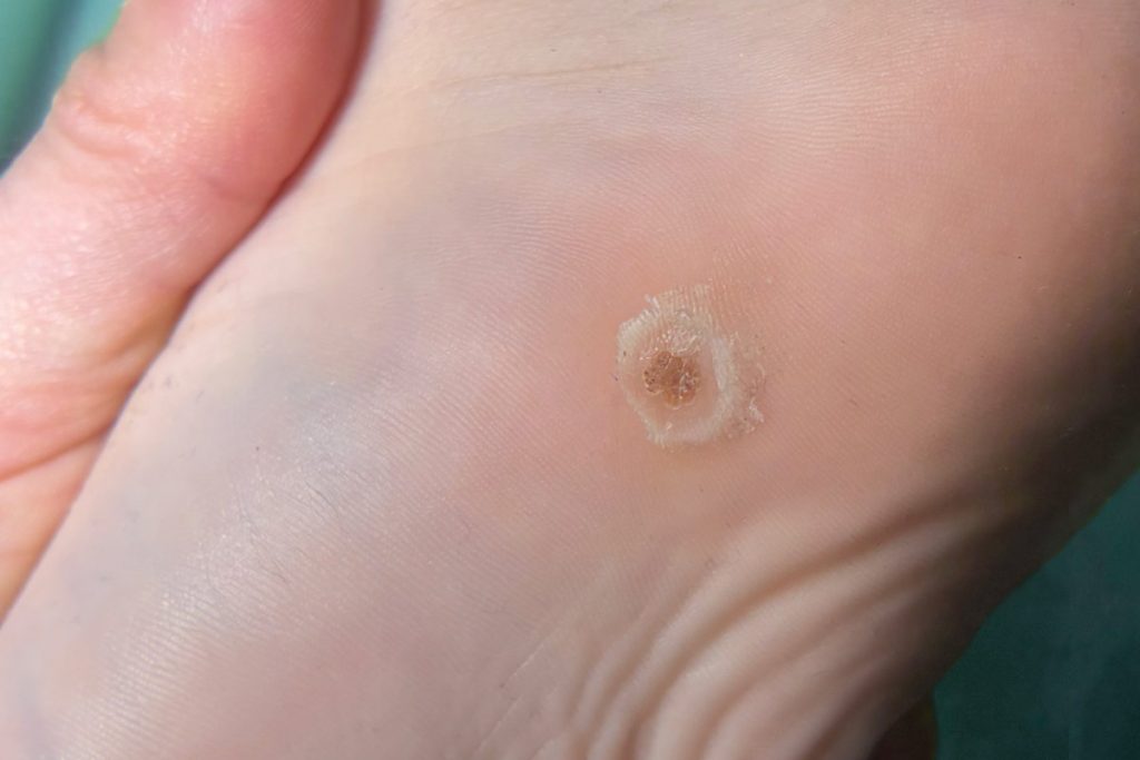 verrugas plantares